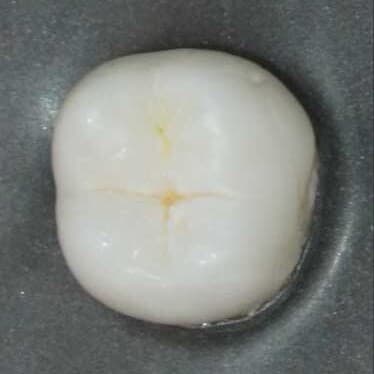 Kaufläche eines Backenzahns unter dem Mikroskop, 10×