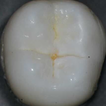 Kaufläche eines Backenzahns unter dem Mikroskop, 22×